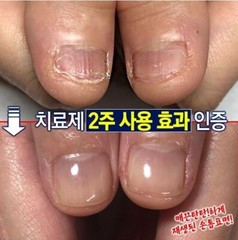 LIGHT PDT nail regeneration supplement 5ml / Made in Korea