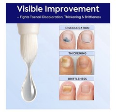 Extra Strength Nail Care Solution: Natural Formula Complete Nail Restoration Kit
