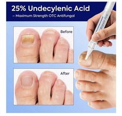 Extra Strength Nail Care Solution: Natural Formula Complete Nail Restoration Kit