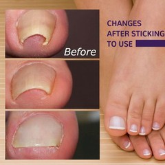 Ingrown Toenail Patch Elastic Nail Corrector Strip Non-Woven Toenail Care Tape