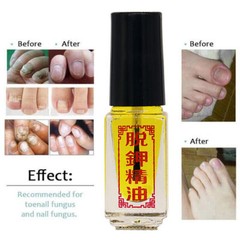 5ml Nail Fungus Foot Care Toe Nails Gel Removal Onychomycosis 3Day Effect