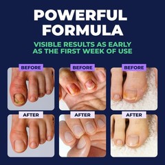 Orivelle Swissclear Fungus Pen for Treatment Fingernails and Toenails Antifungal