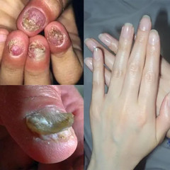Nail Removal Essential Oil Anti-Fungus Oil Removal of Onychomycosis Paronychia