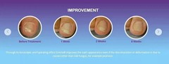 EMTRIX Fungal Nail Treatment ( 10ml ) X 2