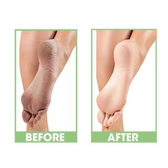 ProLinc Dry Heel Eliminator | Protect and Hydrate 4 Fl Oz (Pack of 1), White