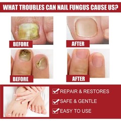 Nail Repair Liquid Antifungal Treatment for Fingernail & Toenail Care 50ml