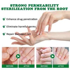 Extra Strong Nail Fungus Treatment Serum Essence Oil Feet Nails Repair Care Esse
