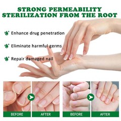 Nutraboost Nail Fungus Treatment Gel, Nail Fungus, Fungus Cream 2026 NEW