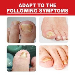Ingrown Toenail Treatment Serum 10ml Toe Nail Repair Corrector Pain Relief Oil