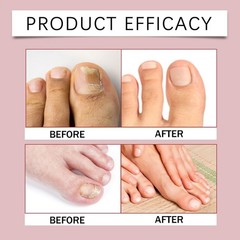 32Pcs Fungal Nail Repair Patch Nail Care Soft Nail Inlay Nail Correction Sticker