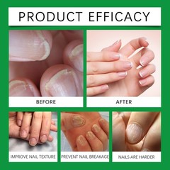 Nail Repair Serum – Softens Cuticles, Corns, and uses on