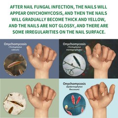 Nail Care Solution with Ginger, Repair Hand, Foot And Nail Care Soft Nail Shine