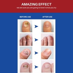 ANTI FUNGAL NAIL REPAIR LIQUID INFECTION ANTIBACTERIAL TOE FINGER TREATMENT-AU