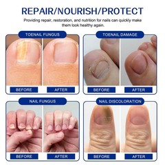 Renewal Fungal Nail Patches Patch Overnight Nail Repair for Nail Fungus Damage