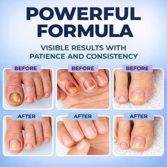 Toenail Fungus Treatment Extra Strength Pen – FSA 0.1 Fl Oz (Pack of 6), Blue