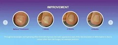 New 3 x EMTRIX Fungal Nail Treatment Visible Results in 1 Week Easy Application