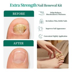 APUREE Fungal Nail Patches Extra Strength: Max 1% Tolnaftate 32 Patch, CLEAR
