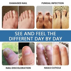 Nail Fungus Relief Spray Safe Gentle Nail Strengthener Toenail Care Spray