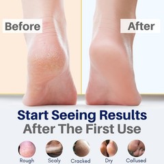 All Natural Foot Cream for Cracked Heels & Dry 4 FL Oz (Pack of 1), yellow