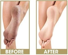 ProLinc Be Natural Callus Eliminator Original Pedicure 4 fl. oz. | 21340