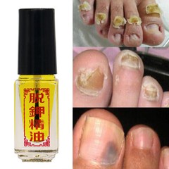 3 Days Effect Really work Nail Treatment Removal onychomycosis Paronychia Toe