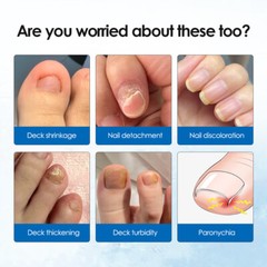 30ml Nail Repair Oil Fungal Nail Treatment Liquid Remove Toe Nail Fungus Essence