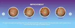 EMTRIX Fungal Nail Treatment ( 10ml ) X 1