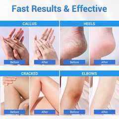Sagry Urea Cream 40 Percent for Feet Maximum Strength, 3.5 Fl Oz (Pack of 1)