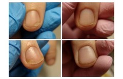 🌿Natural Ingredients OniStop Oil For Nail &Nail Skin Care Treatment Onycholysis