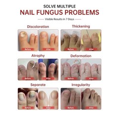 QQE Nail Fungus Treatment Oil 25% Undecylenic Acid, Tea Tree, 30mL