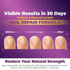 FungiTrim Nail Renewal Serum 1oz – Natural Botanical Formula Supports Healthy Na