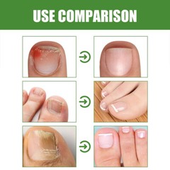 Anti Nail Stick Fungal Shield Anti 1-3PCS Stick Roll On 10ml Fungal Nailshield